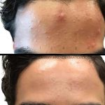 acne before and after