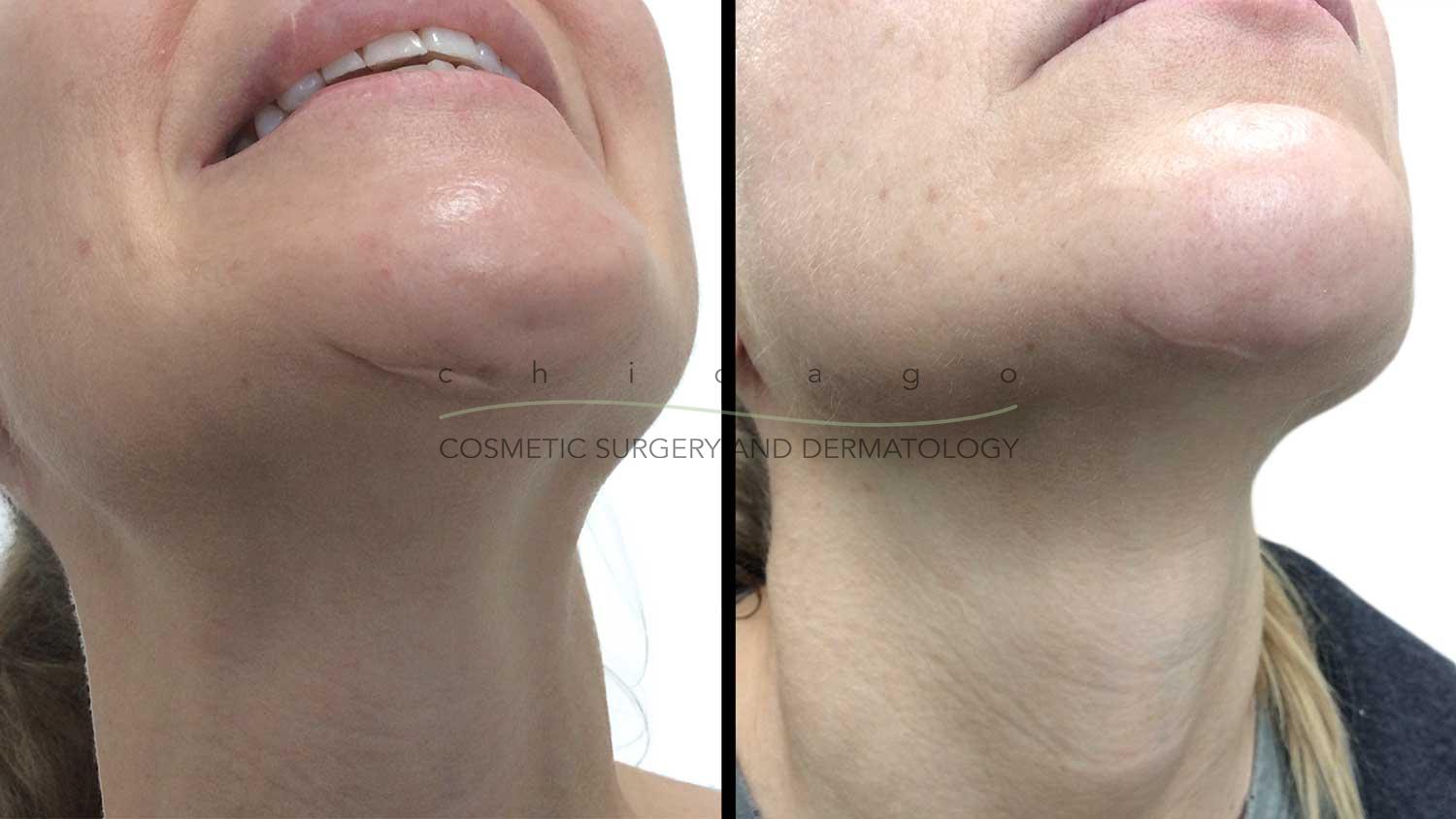 Results of Bellafill injectable filler for scars with Dr. Fine