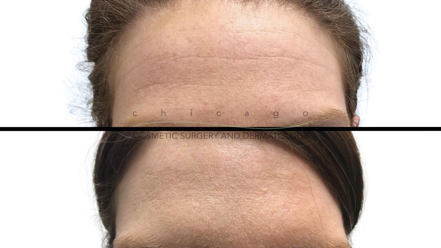 Botox for forehead wrinkles results