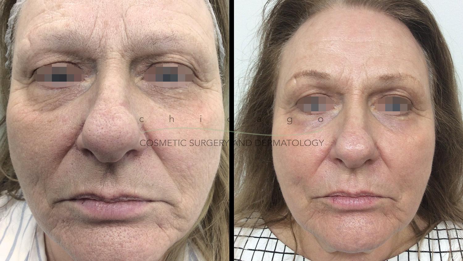 C02 DOT laser resurfacing before and after