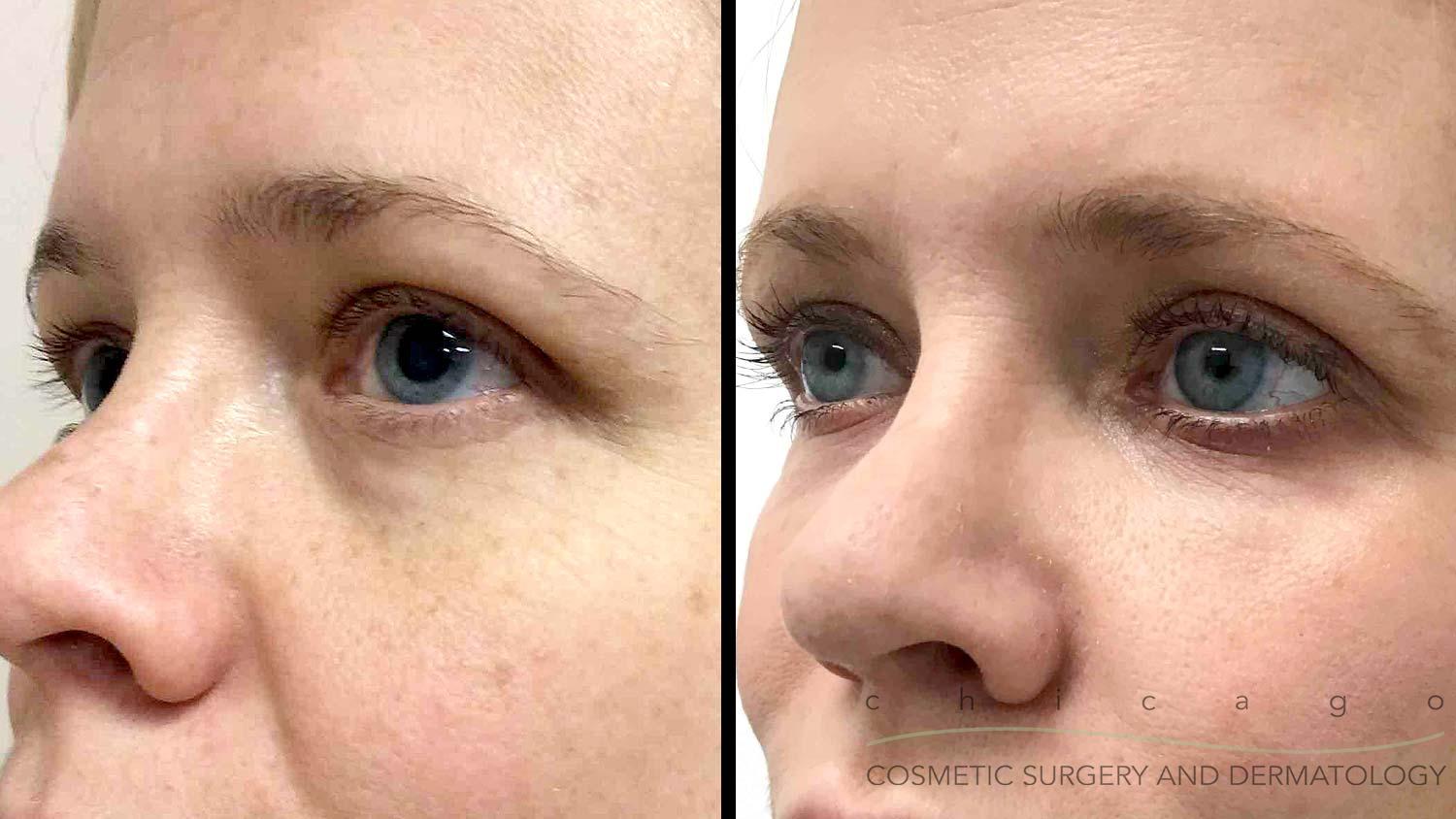 Chicago Madonna Eye Lift before and after