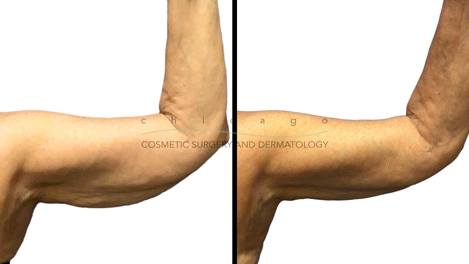 CoolSculpting for arms before and after