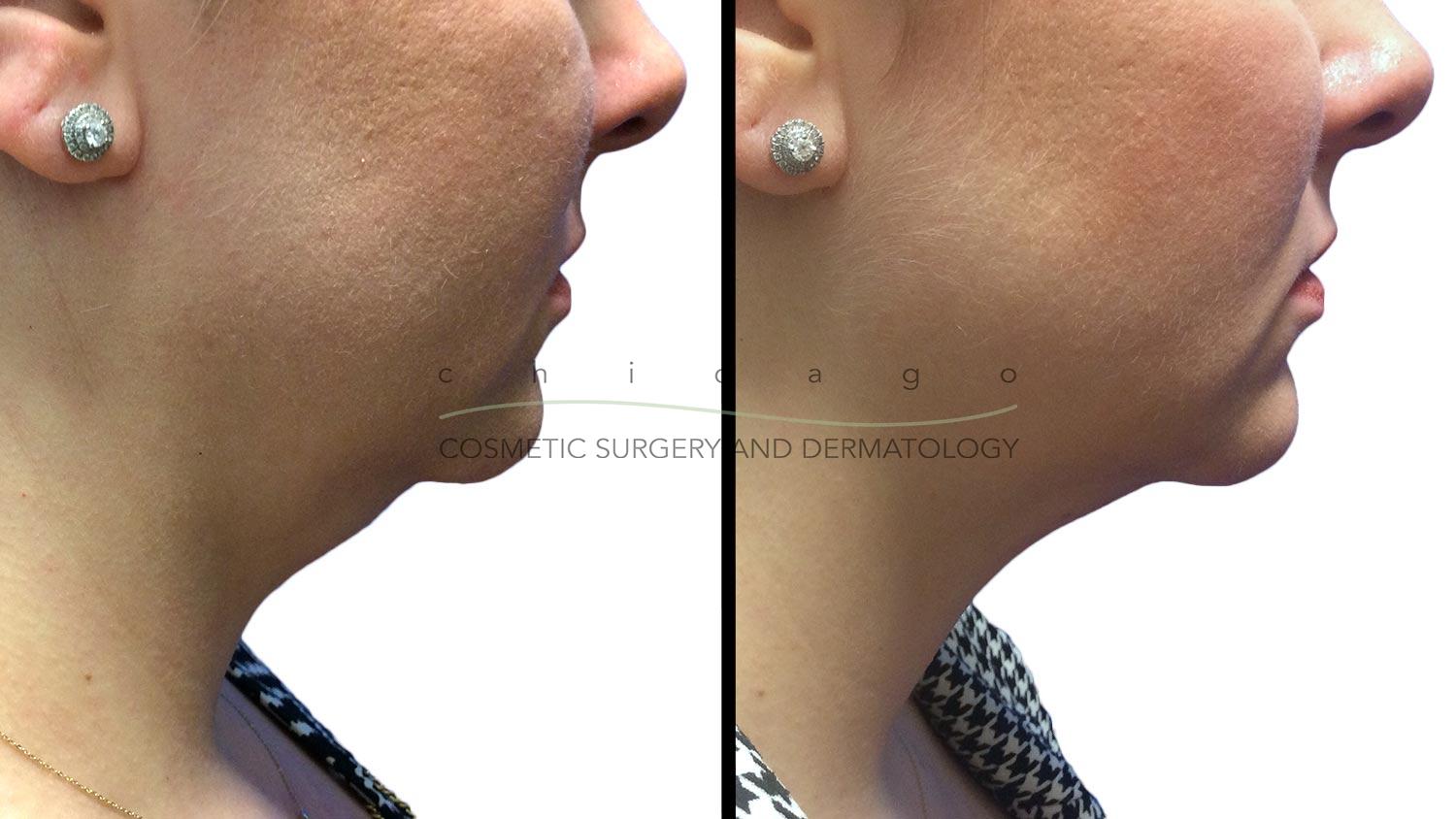 CoolSCulpting chin before and after