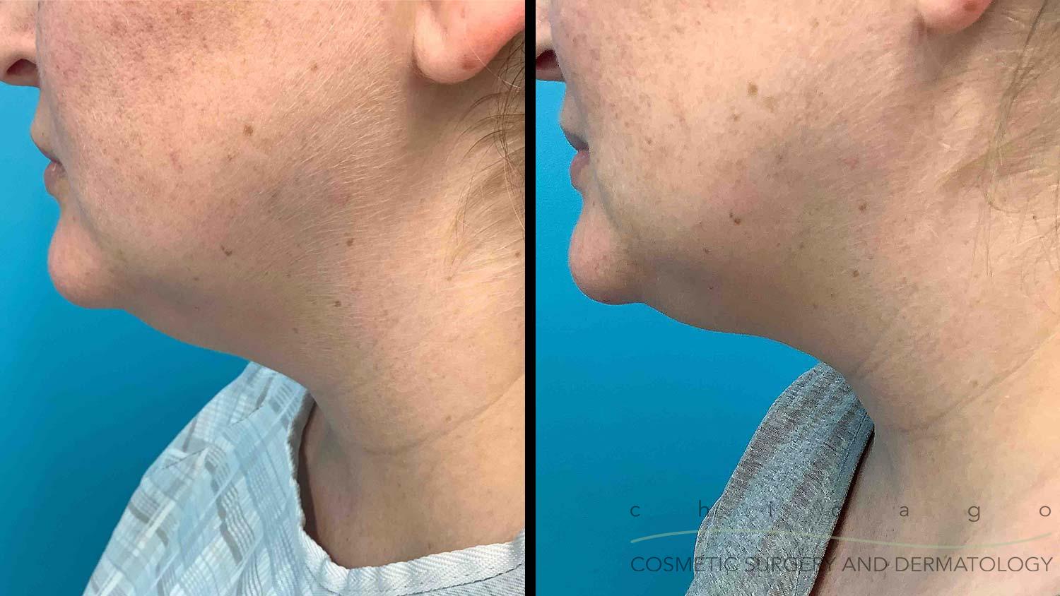 CoolSculpting double chin before and after