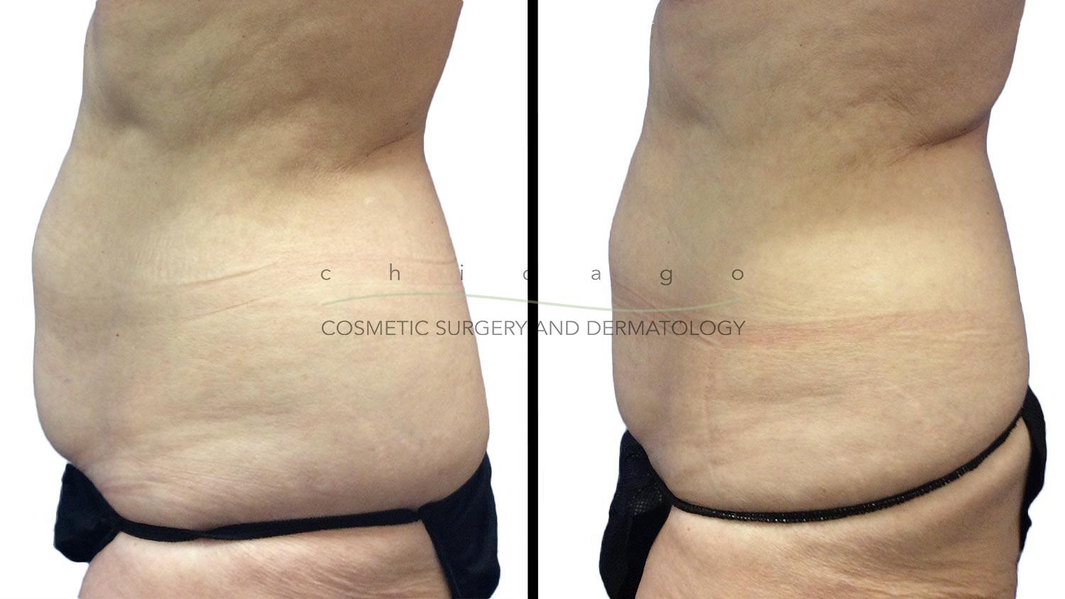 Coolsculpting for Abdomen by Brittany Rank, PA-C
