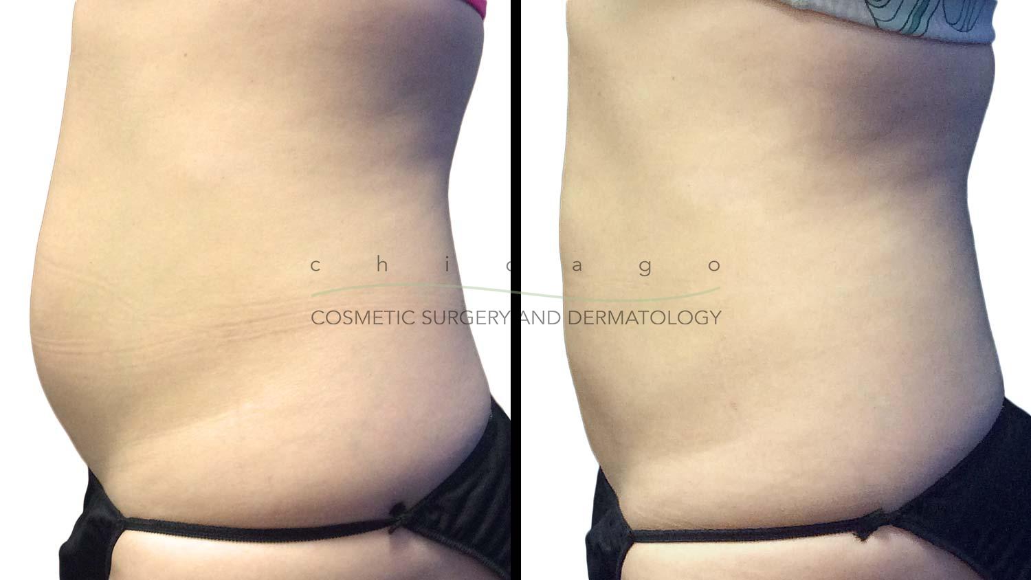 Before and After CoolSculpting