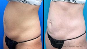 coolsculpting-stomach9