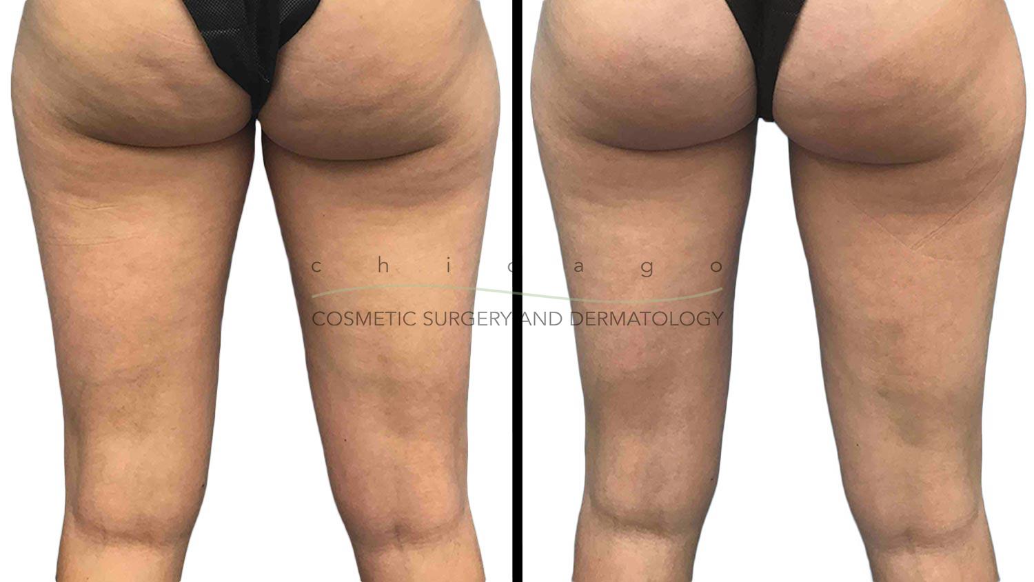 Coolsculpting for Inner Thighs with Brittany Rank, PA-C
