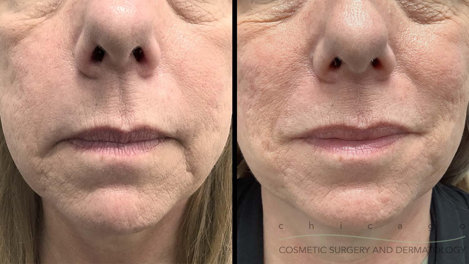 Restylane Defyne filler before and after Chicago Dermatology