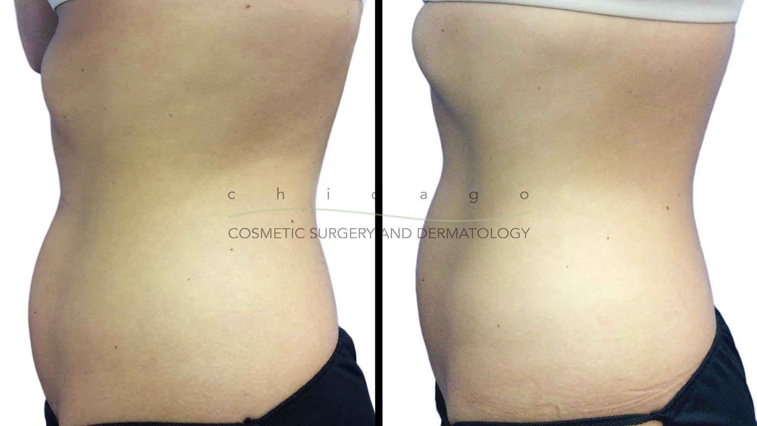 Emsculpt for Abdomen with Brittany Rank, PA-C
