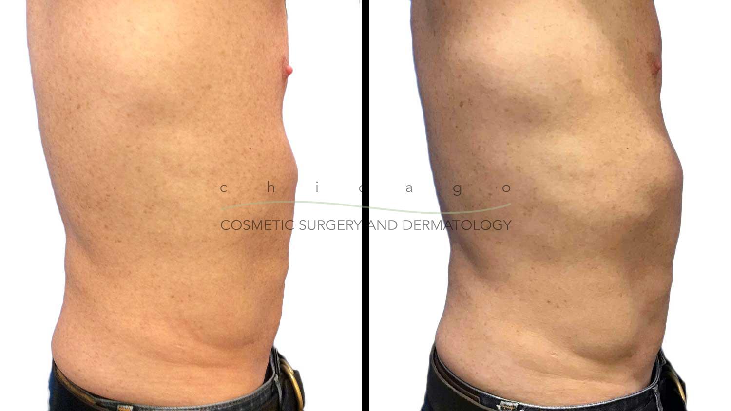Emsculpt abs before and after