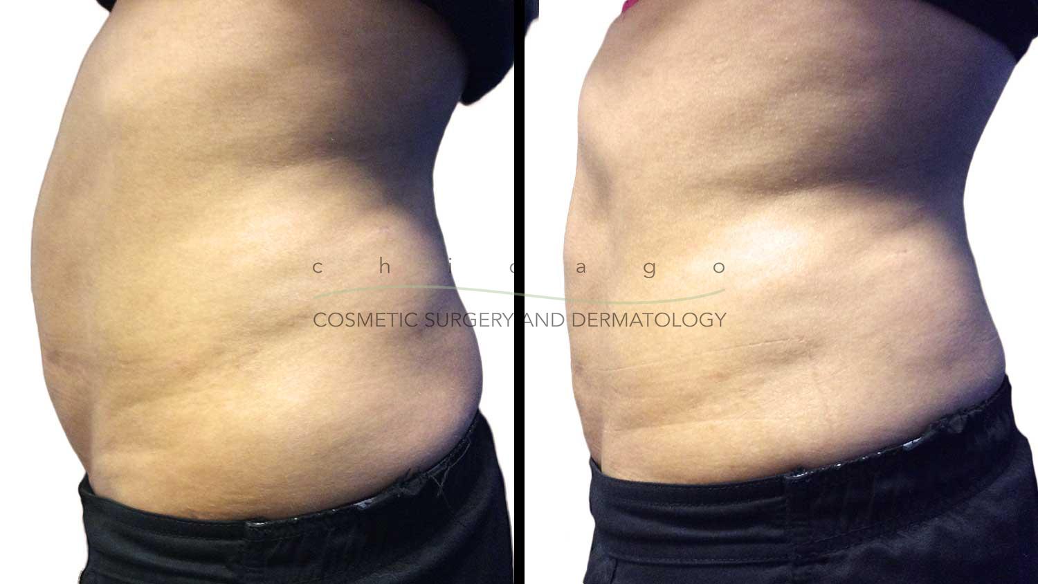 Emsculpt for abs before and after