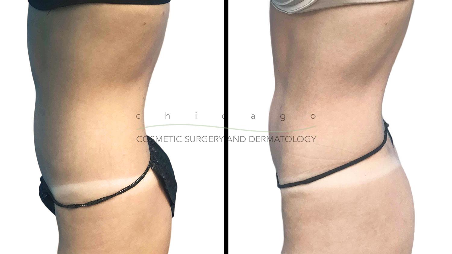 Emsculpt abdomen sculpting before and after Chicago