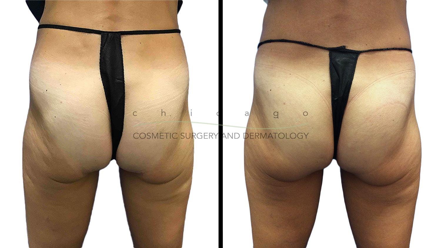 Emsculpt for buttocks with Brittany Rank, PA-C