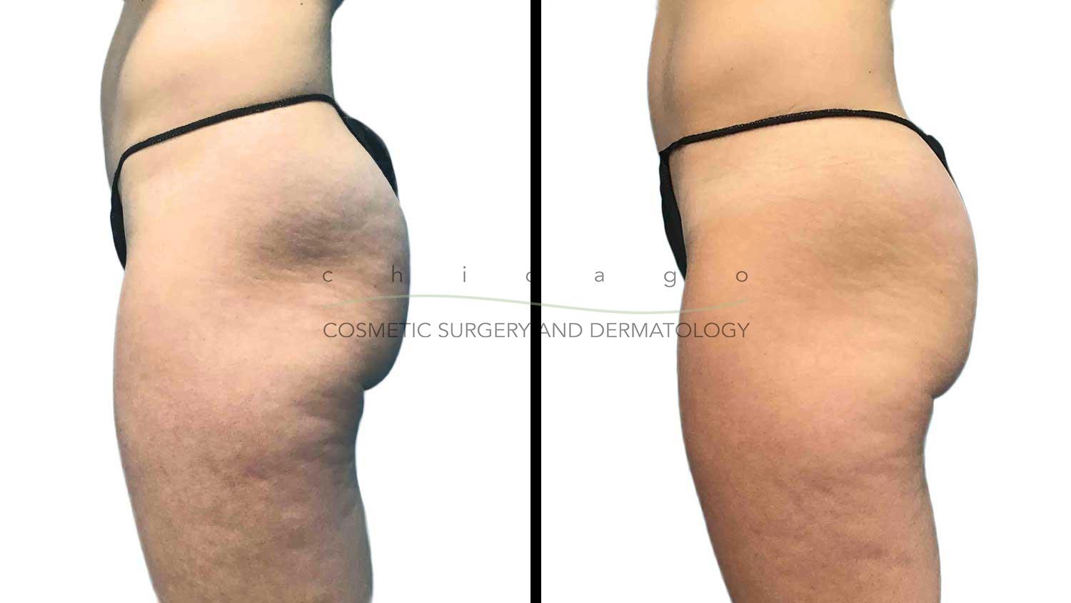 Emsculpt buttocks before and after