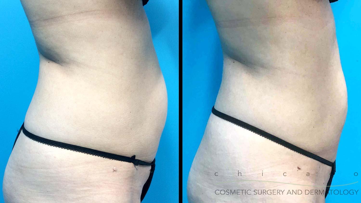 Chicago EmSculpt NEO before and after