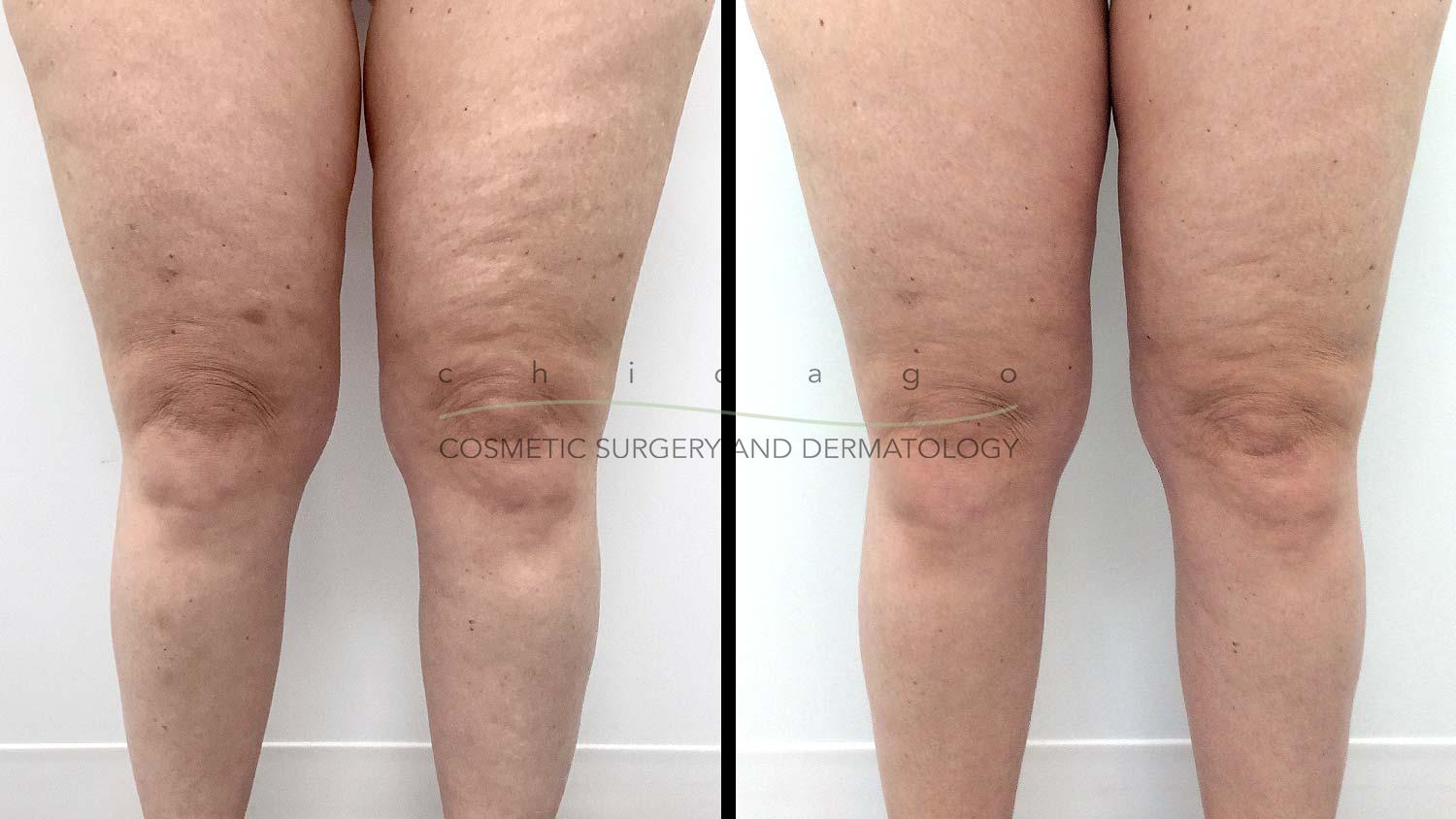 Emtone cellulite before and after