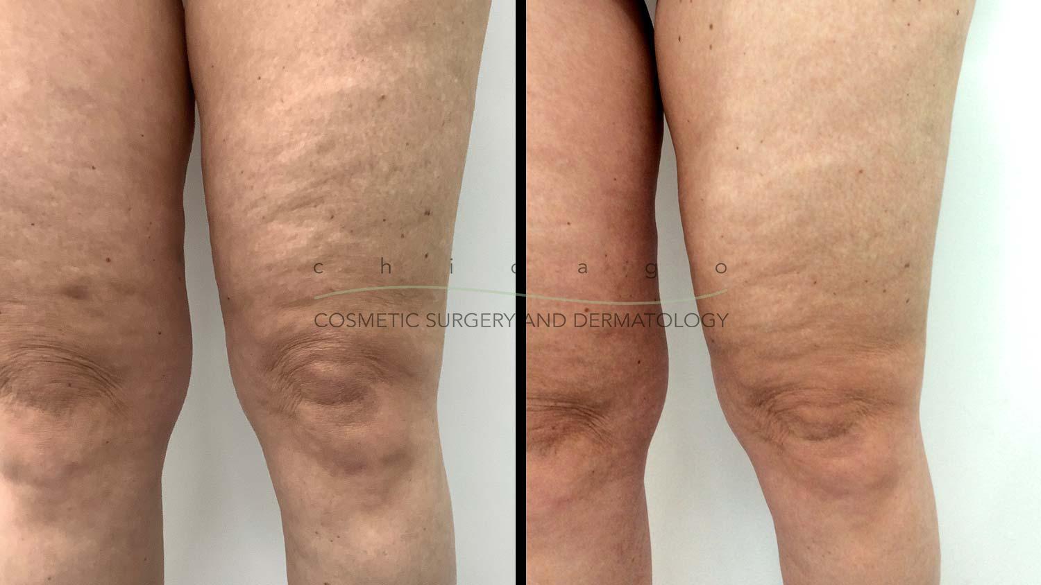 Emtone cellulite before and after