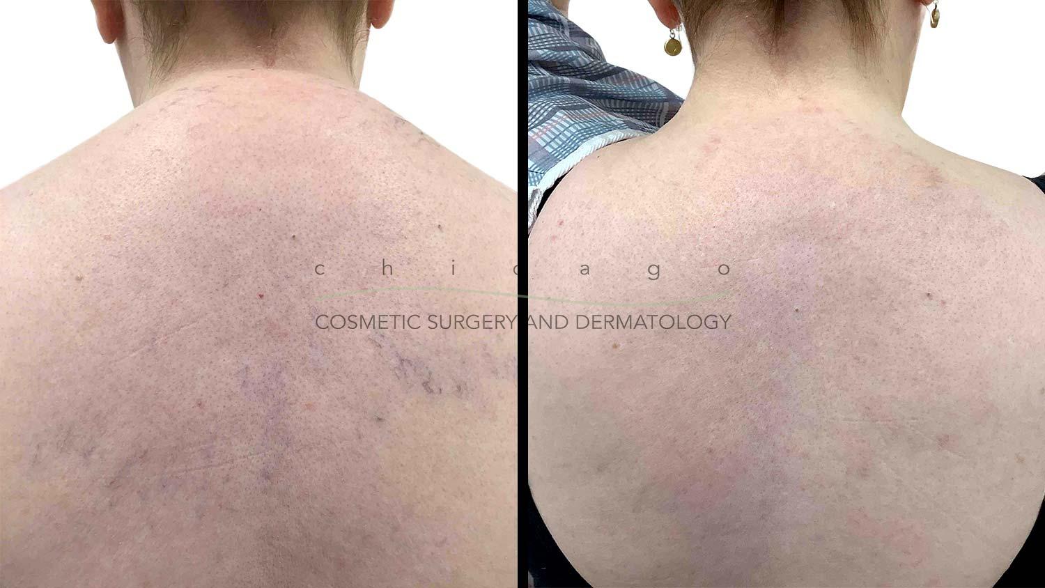 ExcelV laser before and after