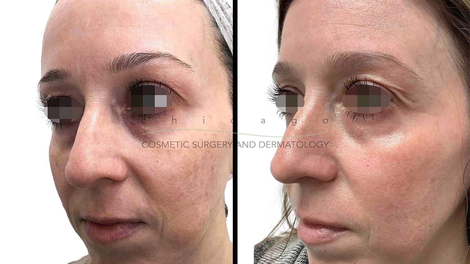 Fraxel Dual before and after melasma