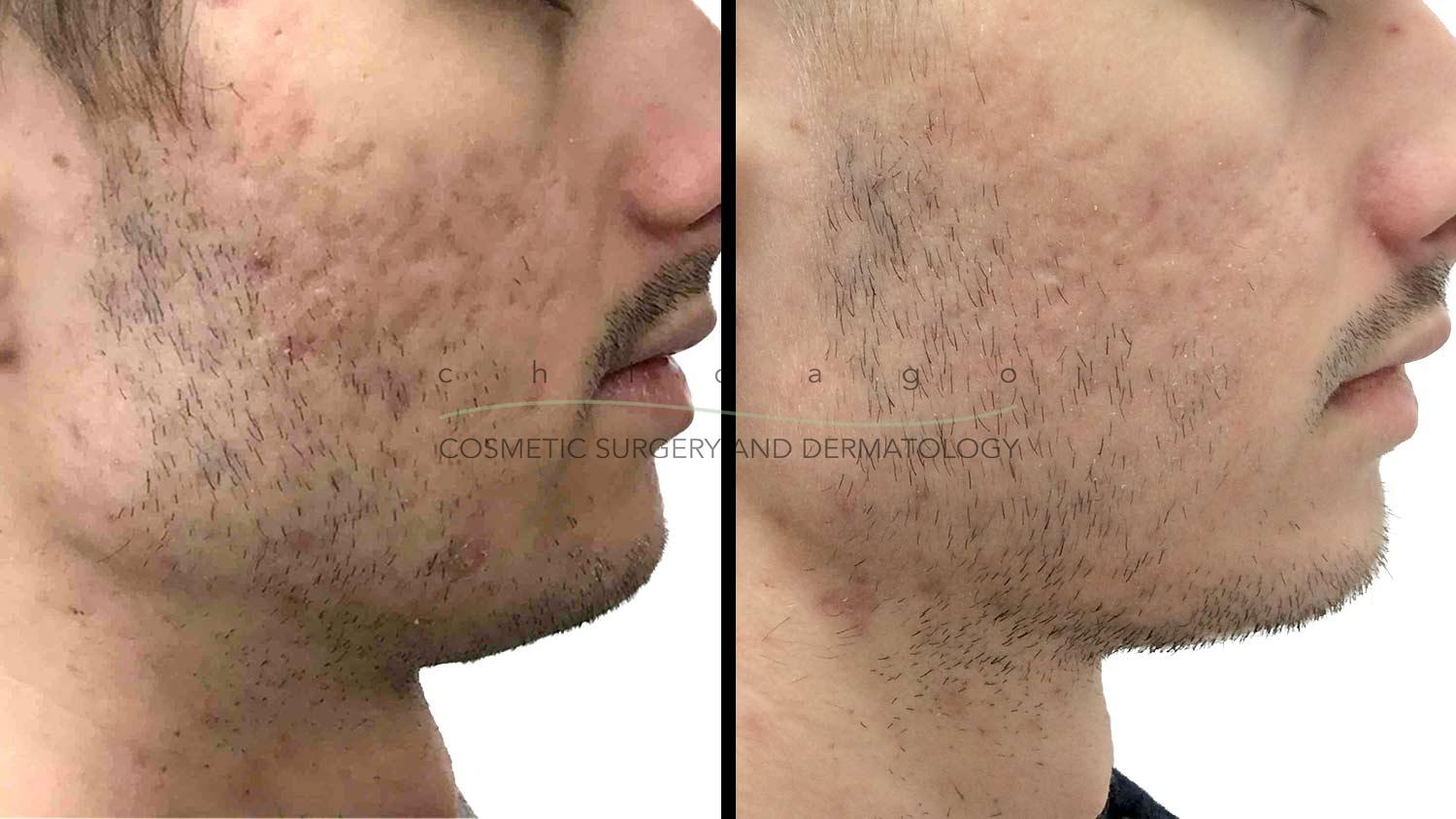fraxel laser resurfacing before and after