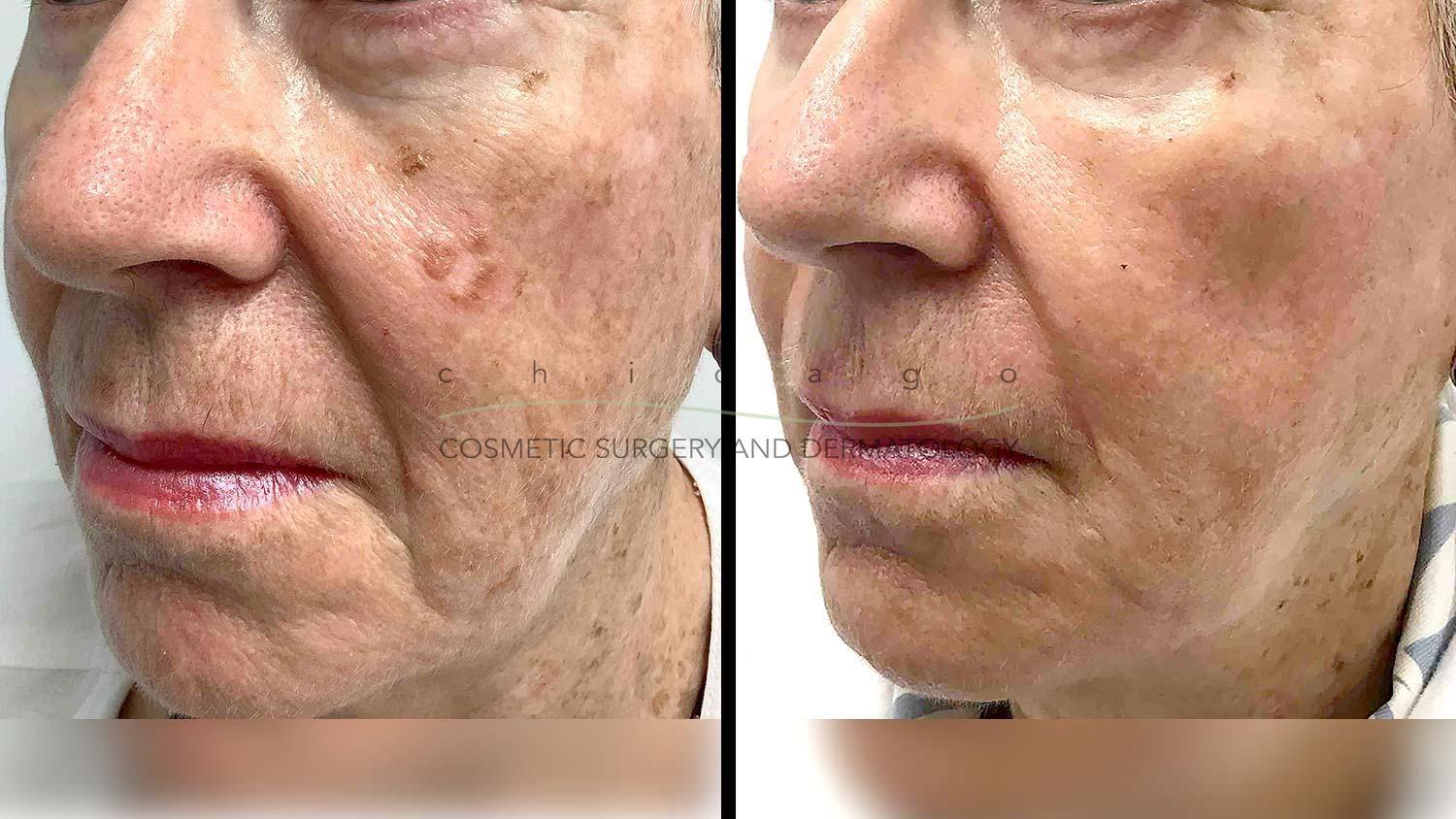 Fraxel DUAL laser before and after