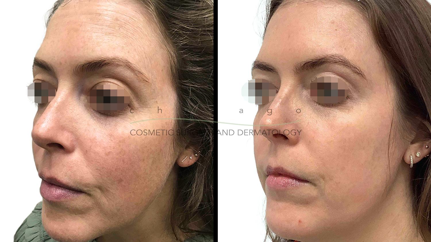 Fraxel DUAL laser before and after