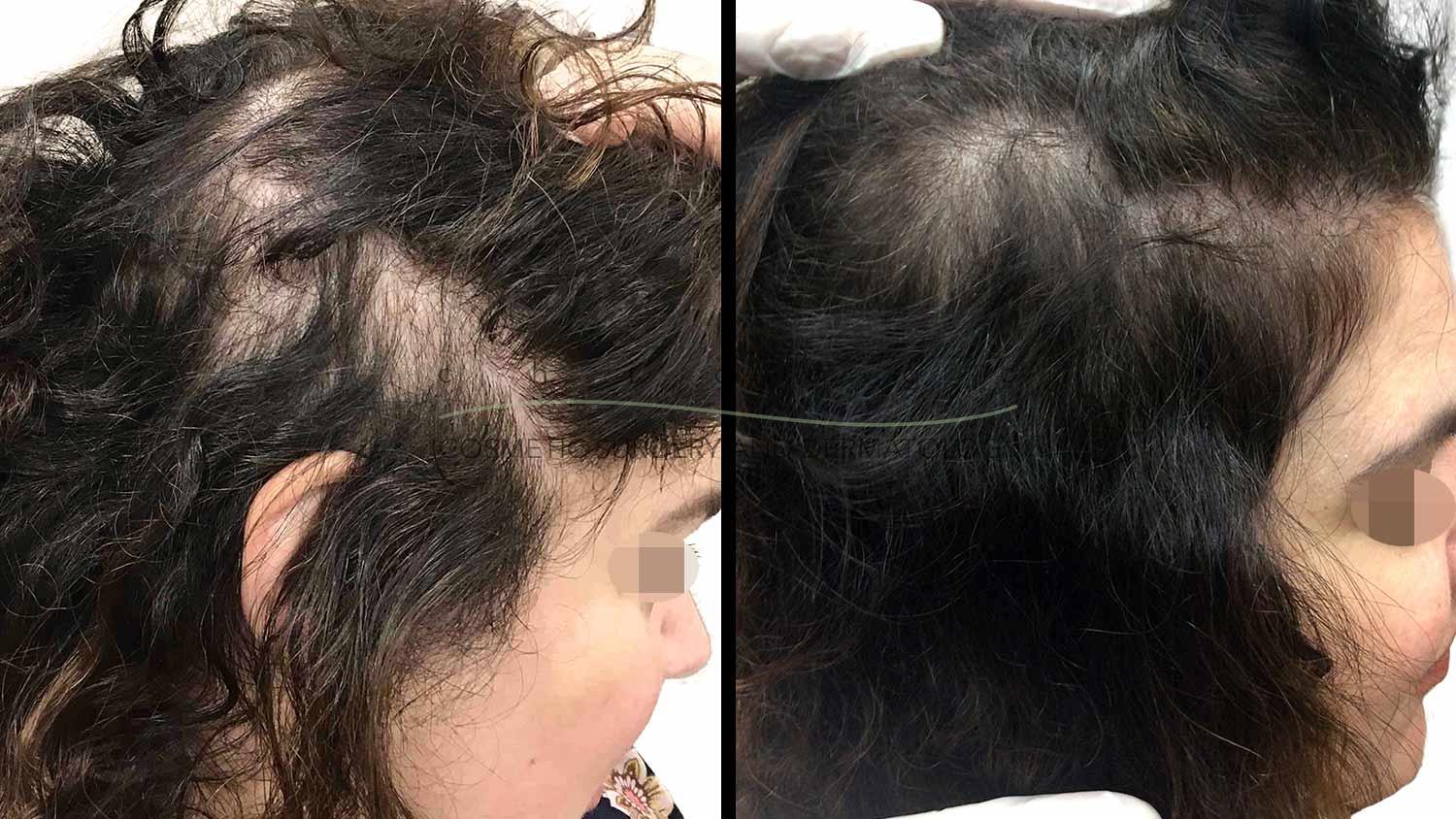 PRP for Hair Loss with Dr. Omer Ibrahim