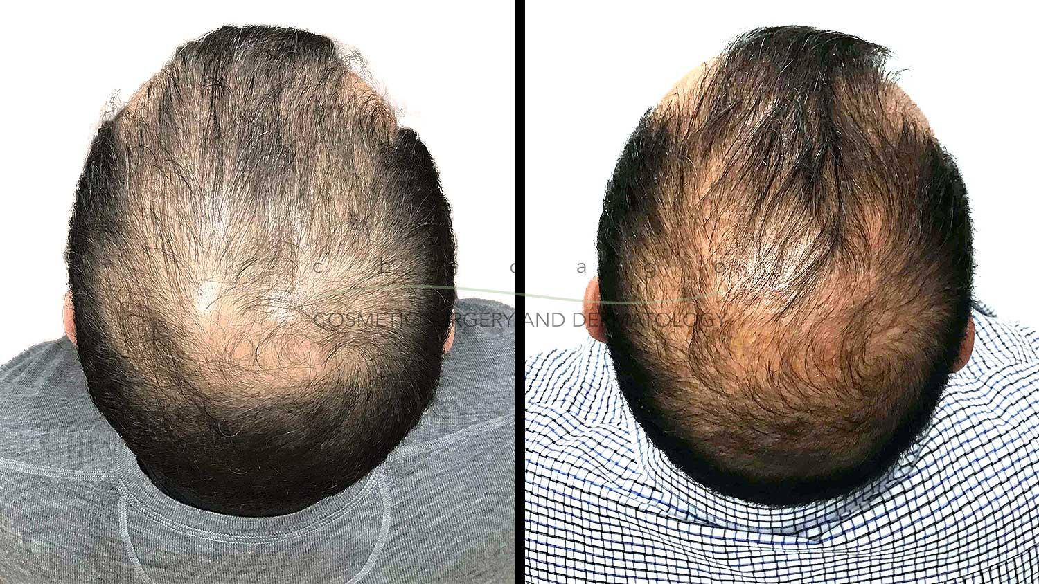 PRP for Hair Loss with Dr. Omer Ibrahim
