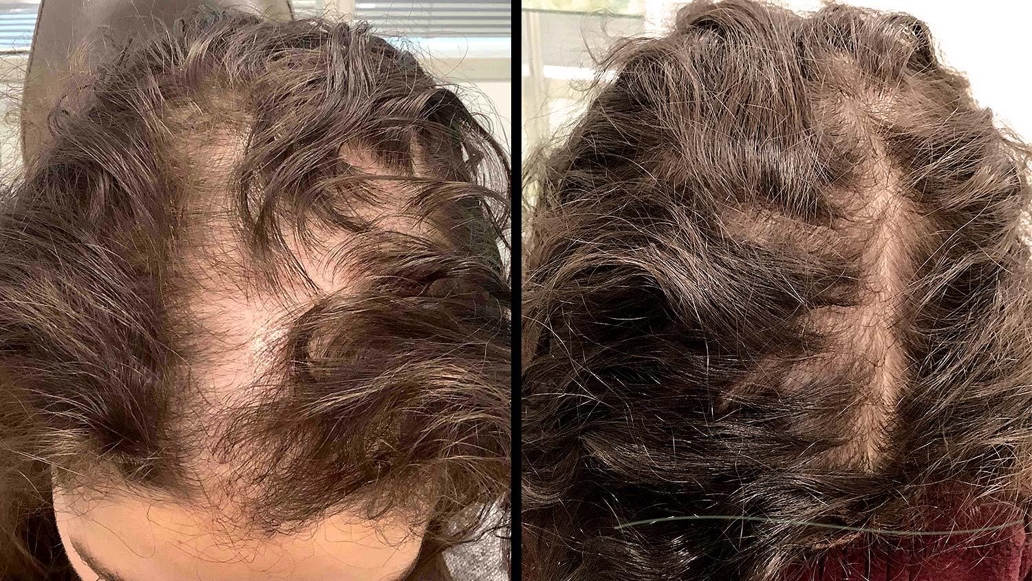 Alopecia hair loss before and after