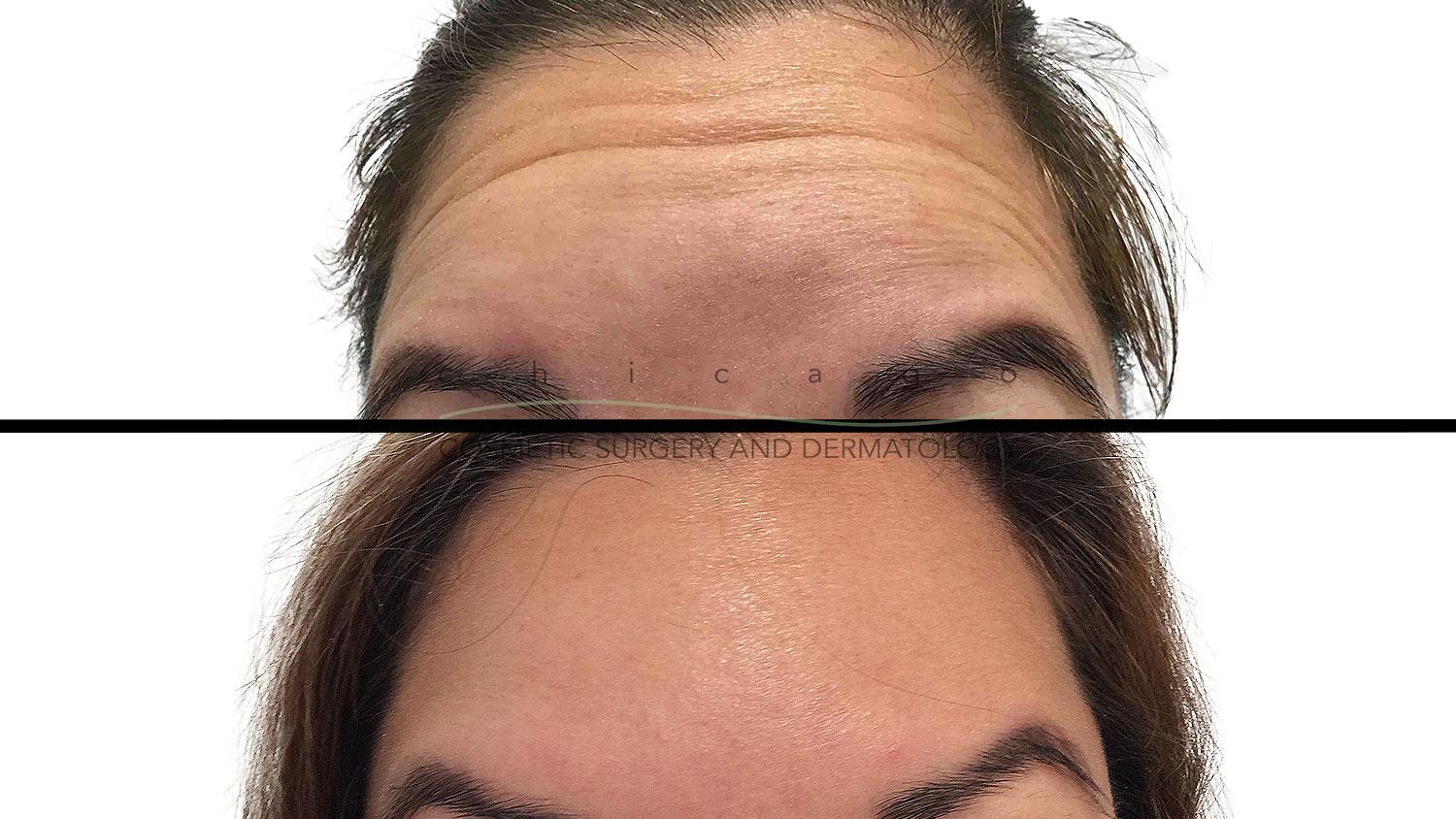 Jeuveau for Forehead Wrinkles results