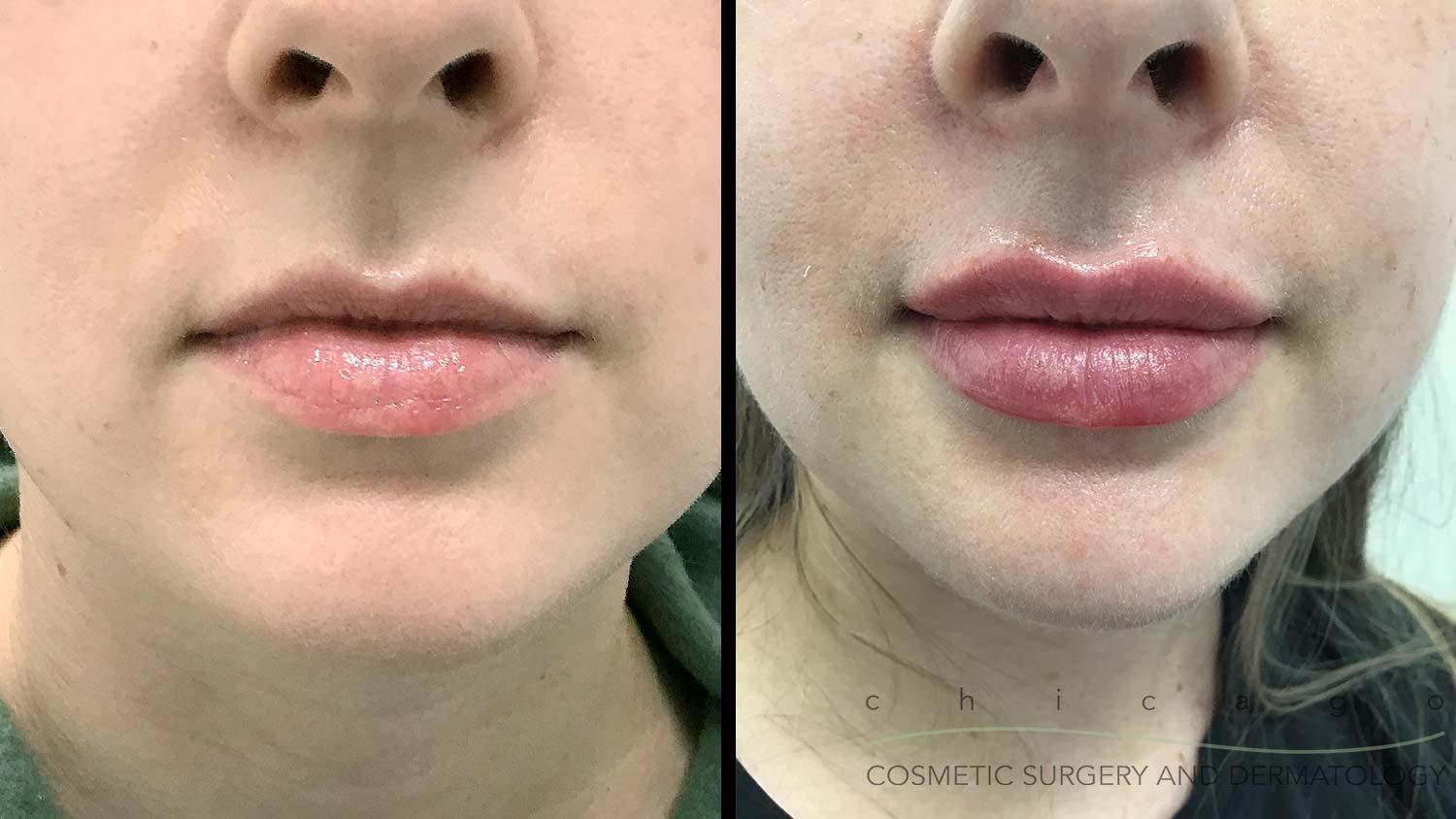Restylane Kysse lip filler before and after