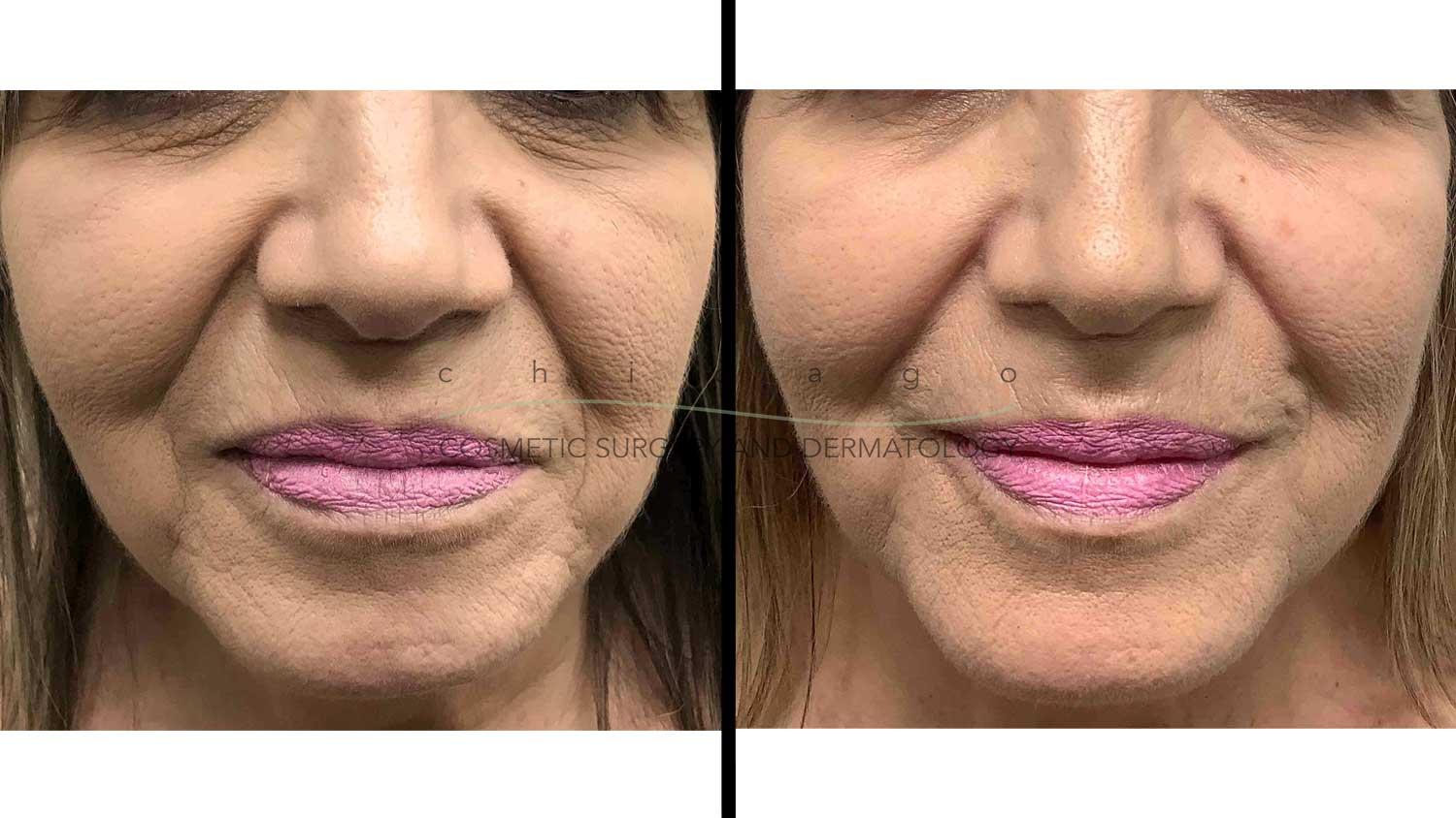 facial rejuvenation from injectable fillers with Dr. Pritzker