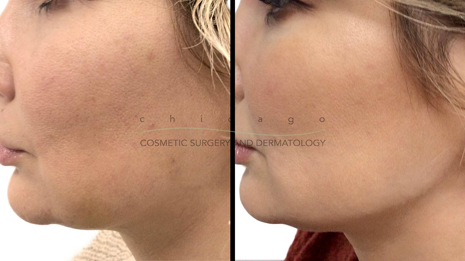 Restylane Lyft filler injectable before and after