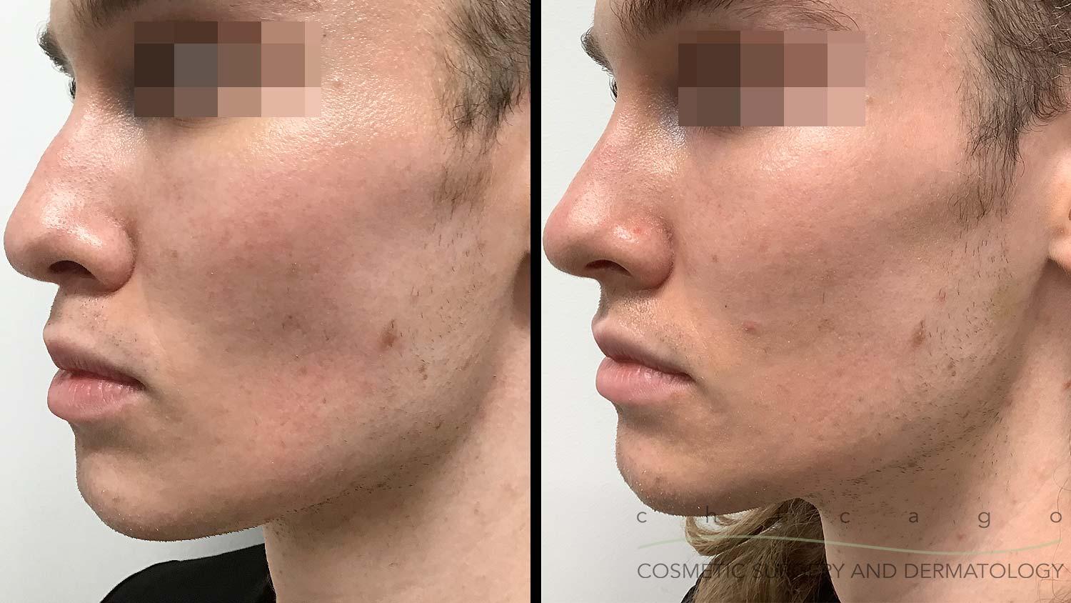 Restylane Lyft filler before and after Chicago