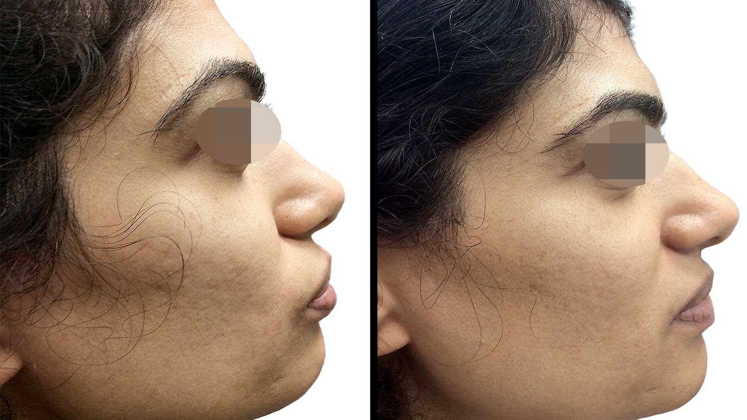 Microneedling with PRP for Acne Scarring with Dr. Rachel Pritzker