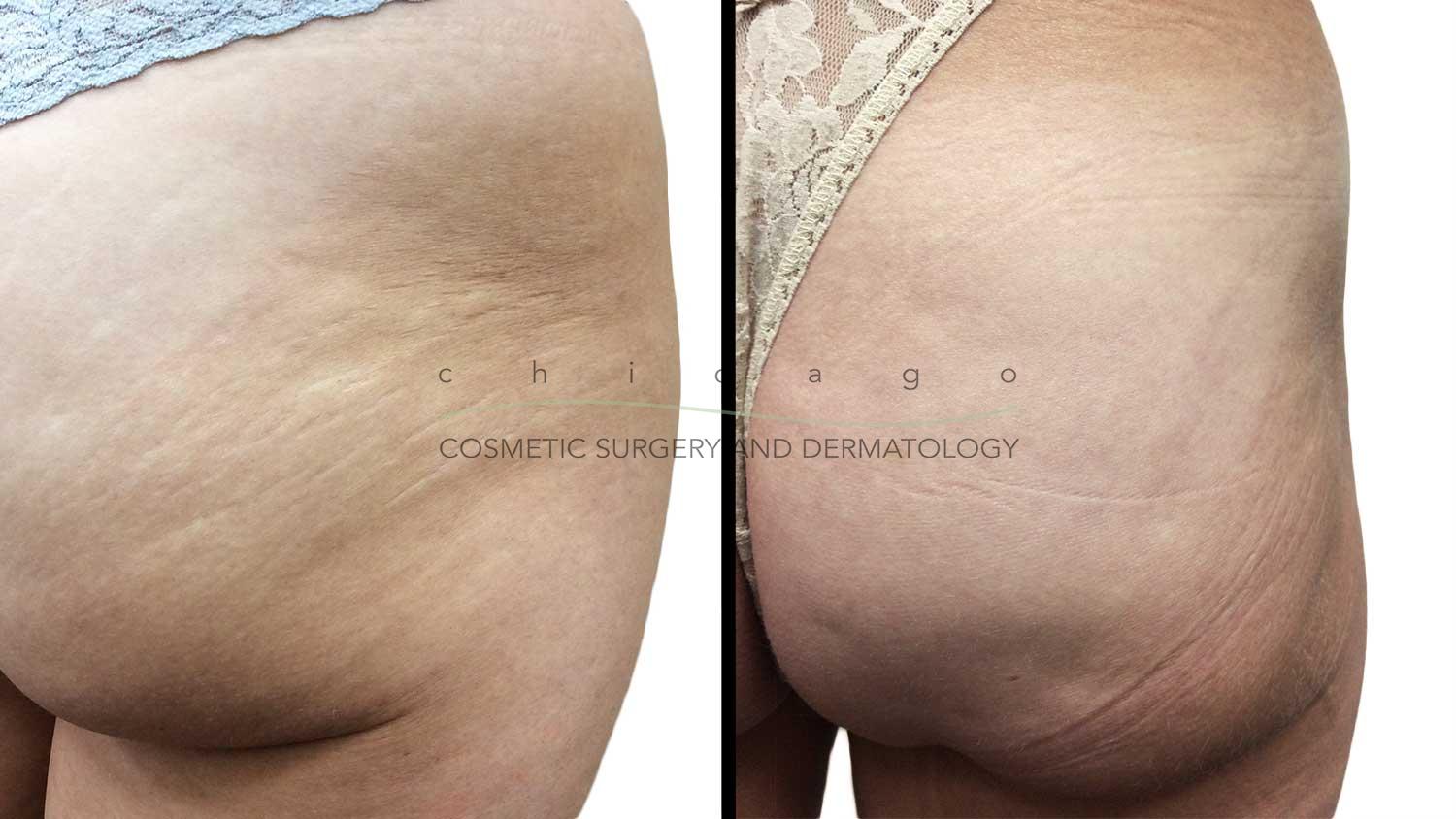Microneedling with PRP for Stretch Marks by Brittany Rank, PA-C