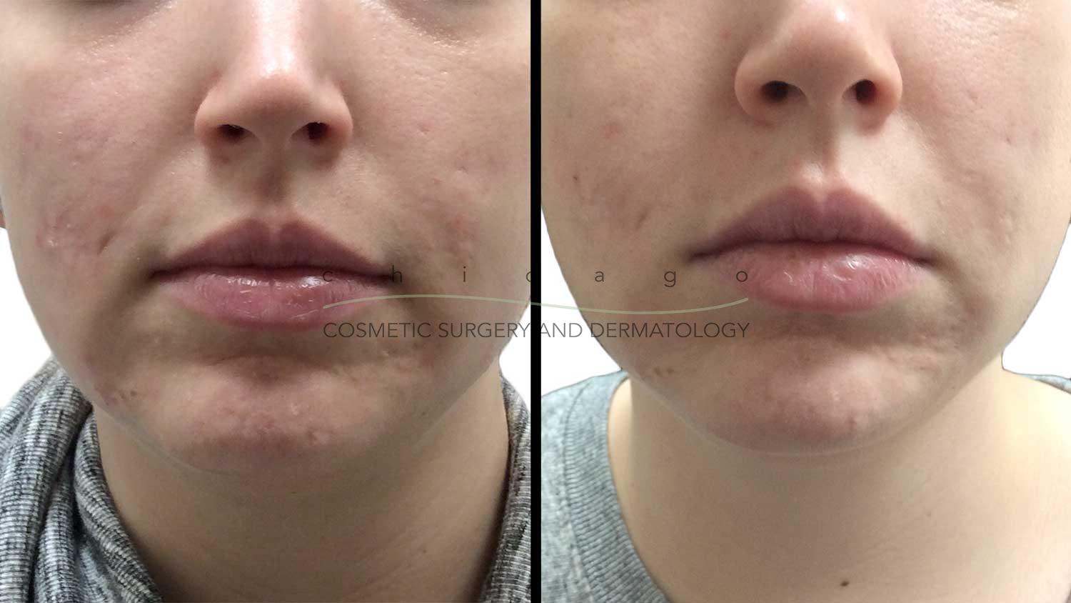 Microneedling with PRP for Acne Scarring by Whitney Hersh, PA-C