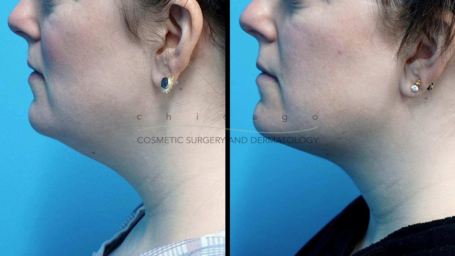 neck liposuction before and after
