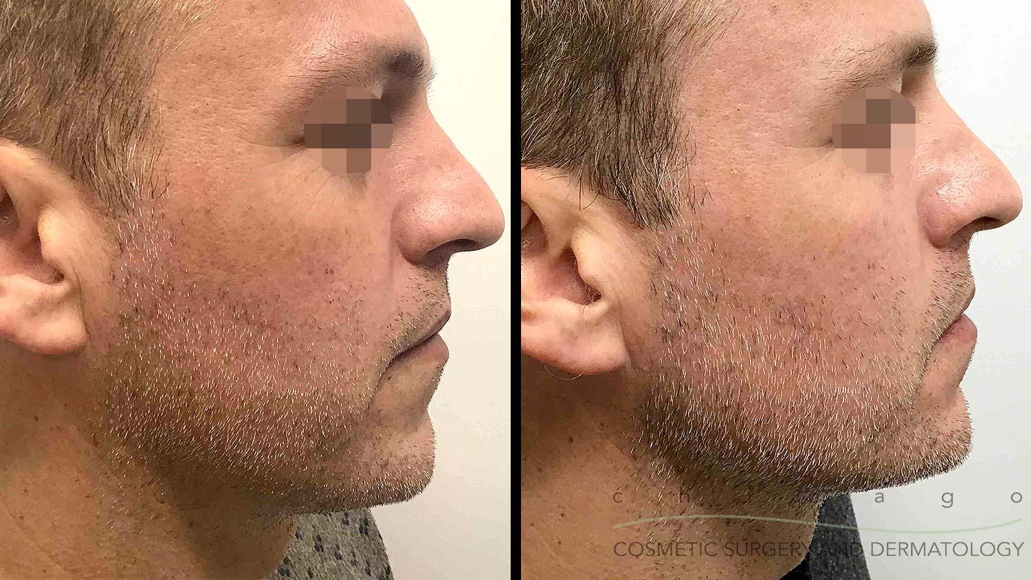radiesse jawline sculpting before and after