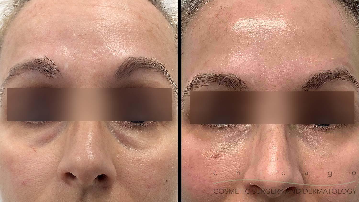 Restylane Refyne under eye before and after