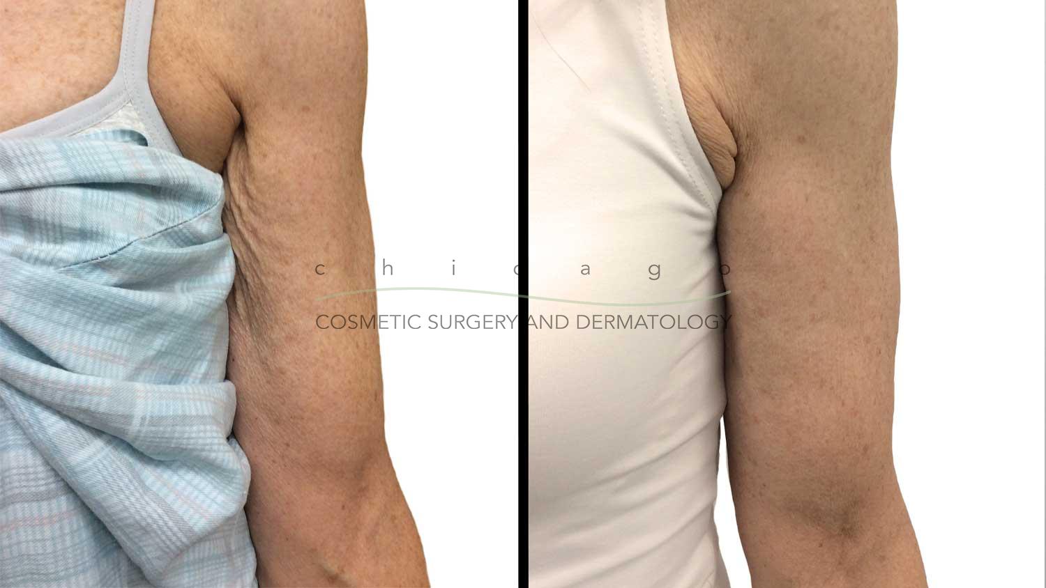 Sculptra for arm crepiness by Dr. Ibrahim