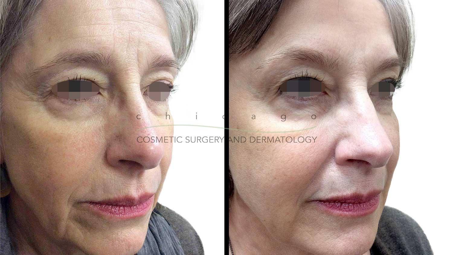sculptra aesthetic before and after
