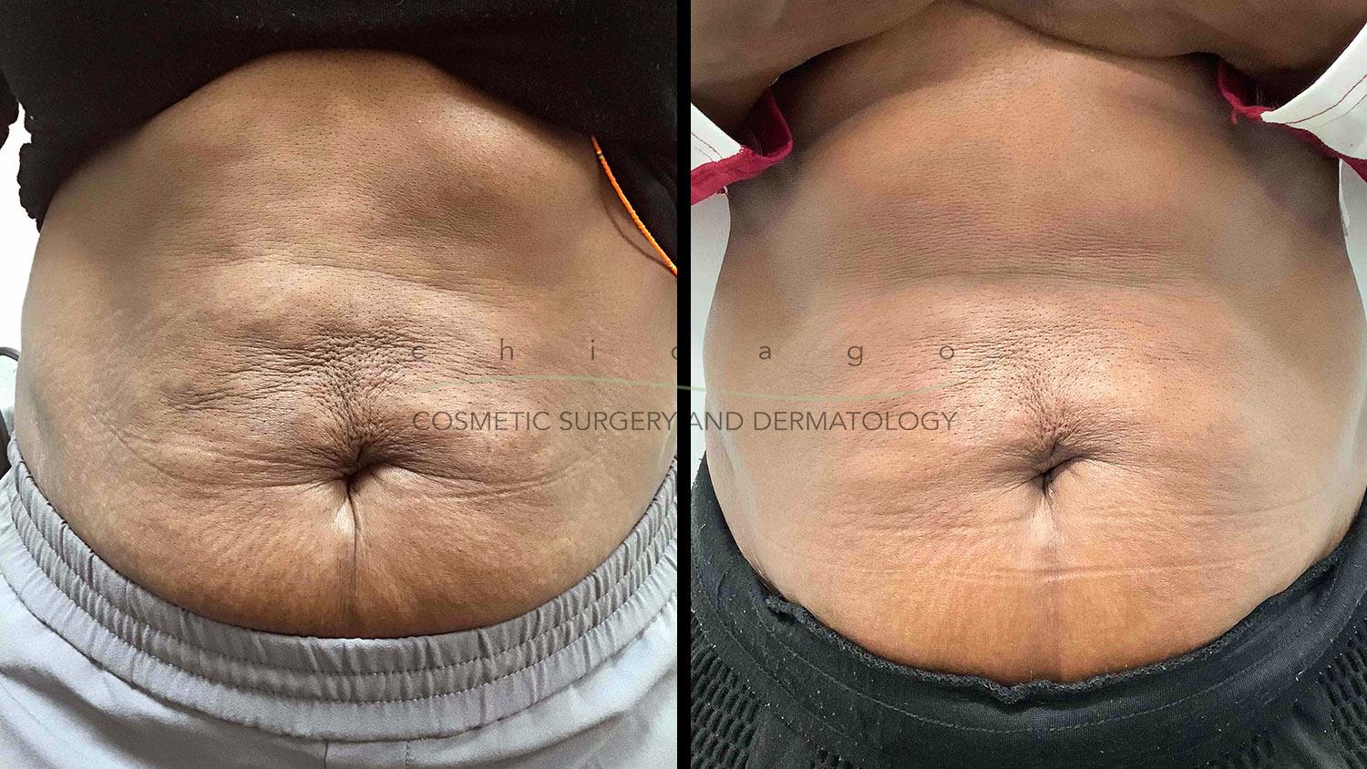 Sculptra Aesthetic before and after