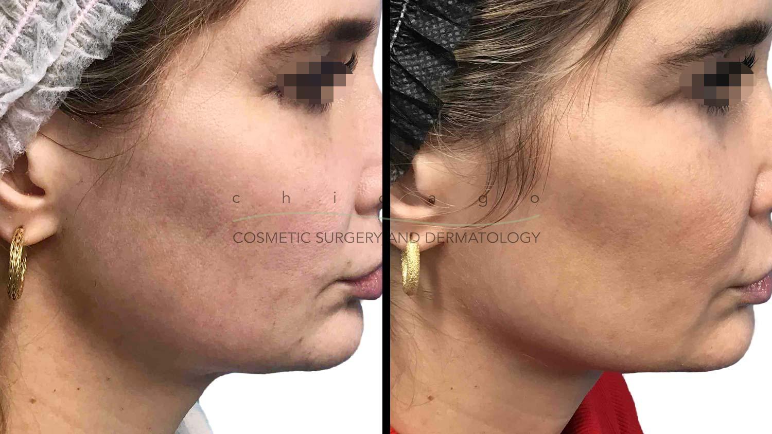Thermage FLX skin tightening for jawline definition Chicago