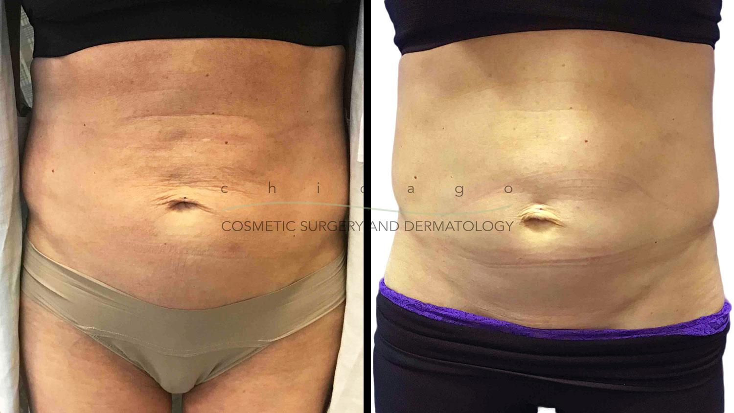 Thermage FLX before and after chicago skin tightening