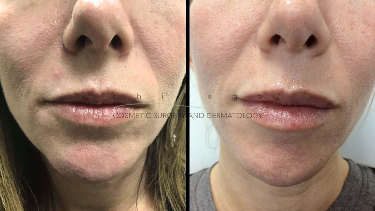 Juvederm Vollure lip filler before and after