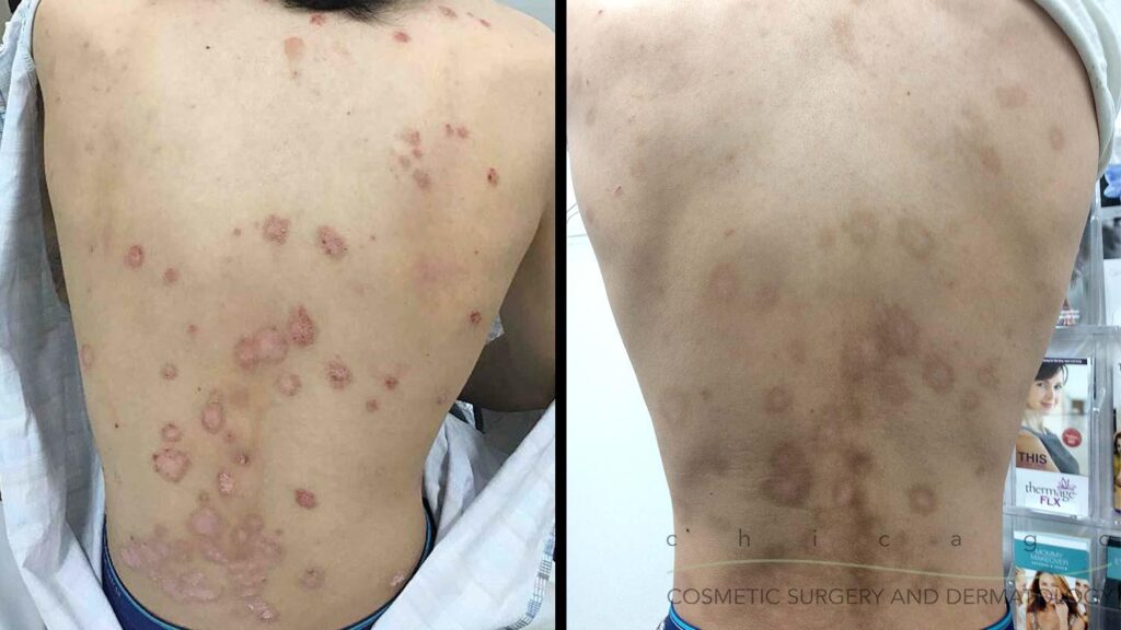 psoriasis before and after