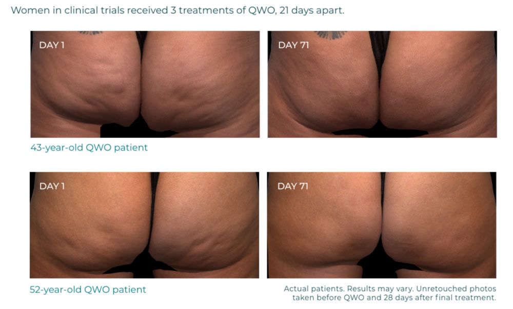 Qwo cellulite before and after