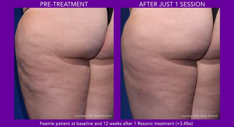 Chicago Dermatology Resonic before and after